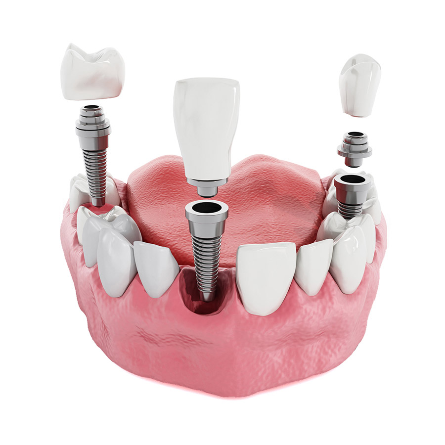 implantologia-dental.jpg